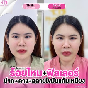 สินค้า ประกาศ ฉีดฟิลเลอร์อุดรธานี ลดริ้วรอย เสริมความงามอุด ยกกระชับ อุดร-ฉีดโบท็อก